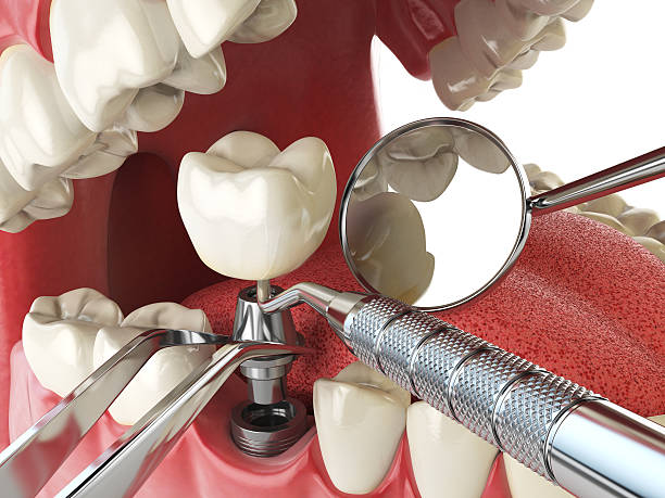 Best Knocked-Out Tooth Emergency  in Desoto, TX